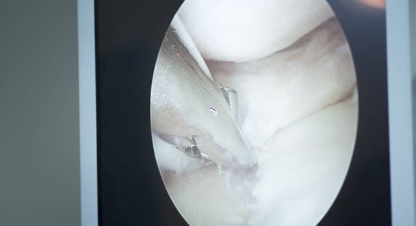 Cirugía de artroscopia
 - Foto, Imagen