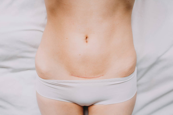 Detailní záběr na ženské břicho s jizvou od císařského řezu - Fotografie, Obrázek