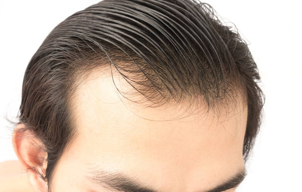 Closeup young man serious hair loss problem for health care shampoo and beauty product concept - Photo, Image