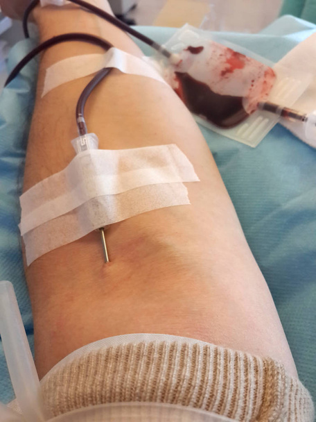 brazo con aguja durante la transfusión de sangre
 - Foto, Imagen