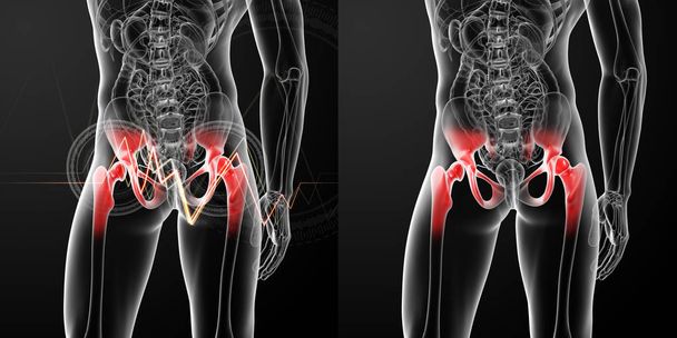 3D rendering medical illustration of a painful hip joint  - Photo, Image