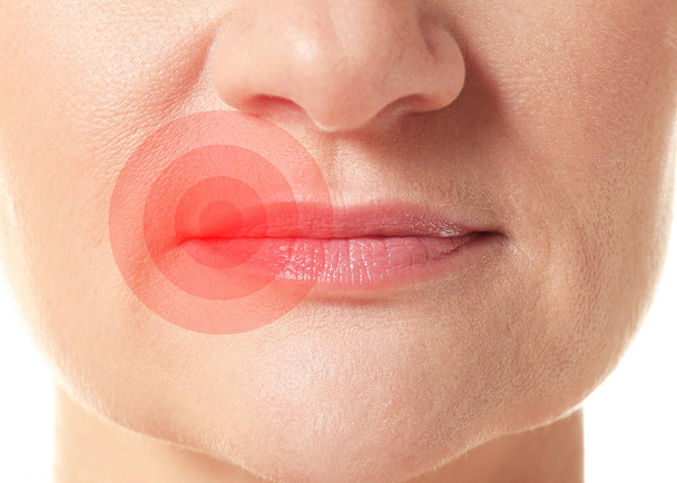 Female lips with herpes virus, closeup - Foto, afbeelding