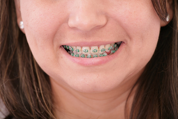 Close-up of a smiling young teenager with braces - Photo, Image