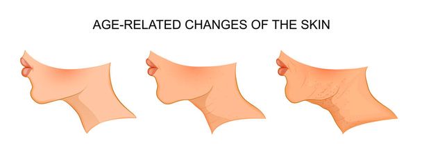 加齢に伴う肌の変化の図。高齢化 - ベクター画像