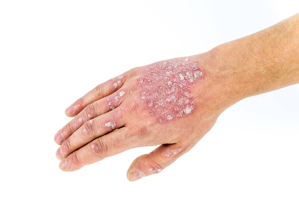 psoriasis en la mano aislada en blanco
 - Foto, imagen