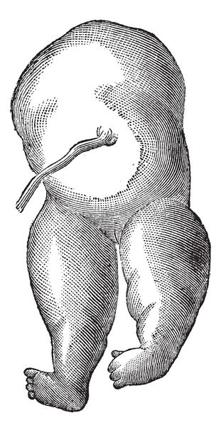 Фиг. 436. Ацефалия тип цефалического расстройства, винтажная гравировка
 - Вектор,изображение
