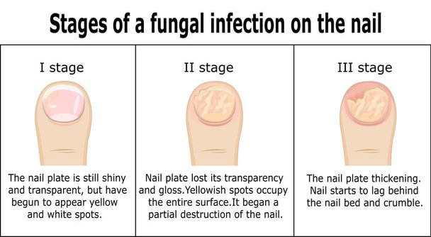 Стадии грибковой инфекции на ногтях
 - Вектор,изображение