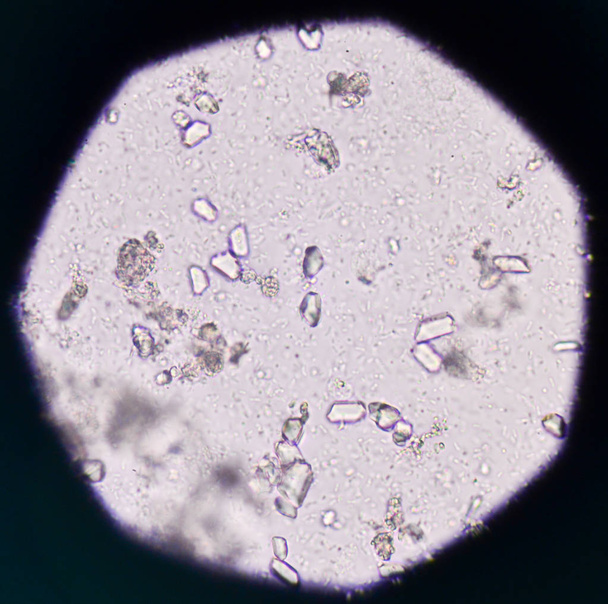 Moderate triple phosphate with bacteria in urine analysis medica - Photo, Image