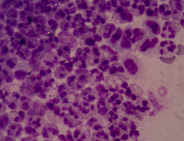 Ракових клітин в людському показ аномальних клітин. - Фото, зображення