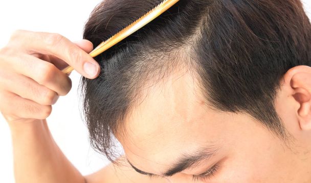 Young man worry hair loss problem for health care shampoo and beauty product concept - Photo, Image