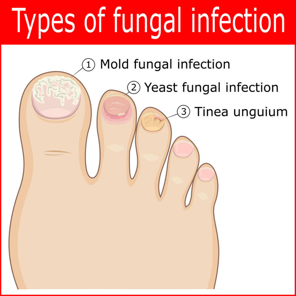 Types of fungal infections - Vector, Image