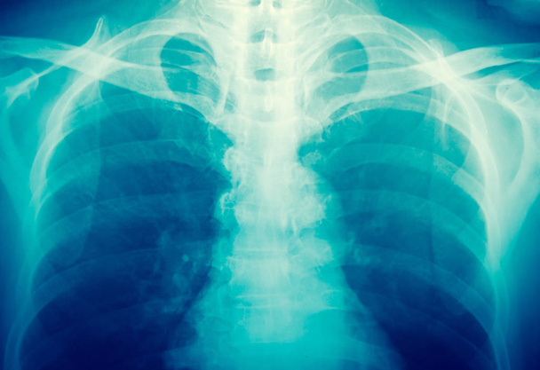 A kék tónust röntgen - Fotó, kép