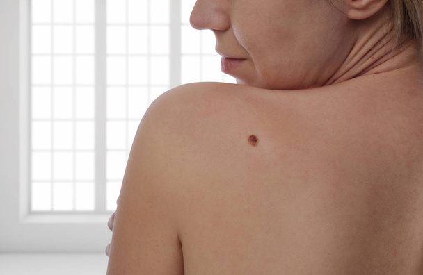 Checking benign moles : Woman with birthmark on her skin - Fotoğraf, Görsel