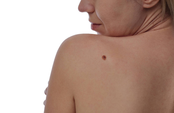 Checking benign moles : Woman with birthmark on her skin isolated on white background. - Fotoğraf, Görsel