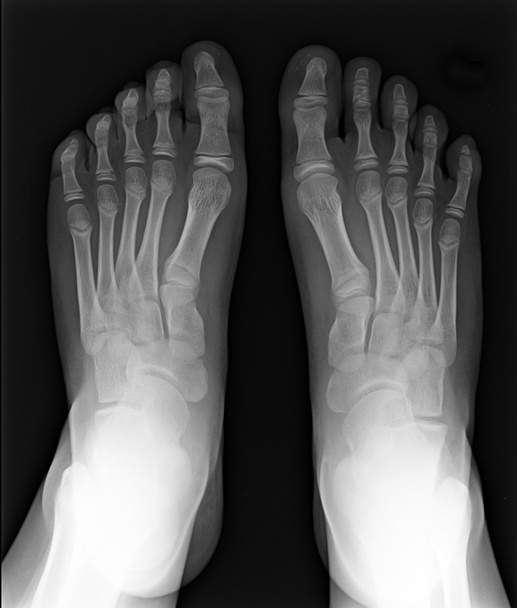 δάχτυλα ποδιών που εκτίθενται σε μαύρο και λευκό φιλμ ακτίνων χ, μαγνητική τομογραφία - Φωτογραφία, εικόνα