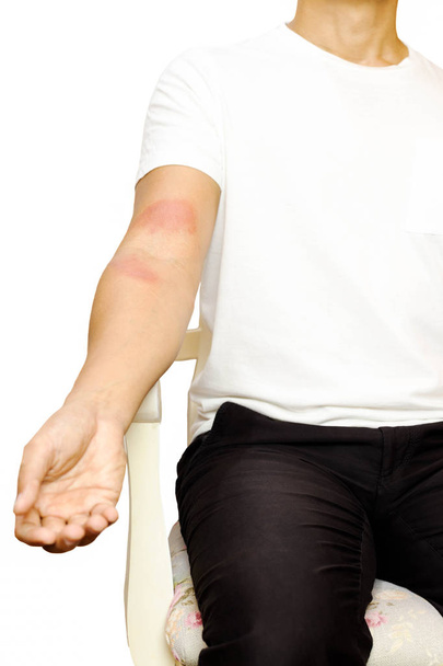 Homme avec éruption cutanée allergique sur son bras isolé
  - Photo, image