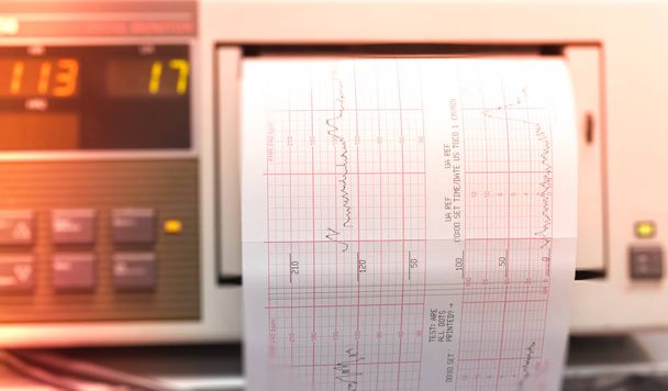Afdrukken van cardiogram rapport afkomstig van Electrocardiograaf iin verloskamer - Foto, afbeelding