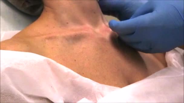 Lääkäri ihotautilääkäri desinfioi kaulan ihon ennen kauneutta menettely botulinum toksiini nuorentaa
 - Materiaali, video