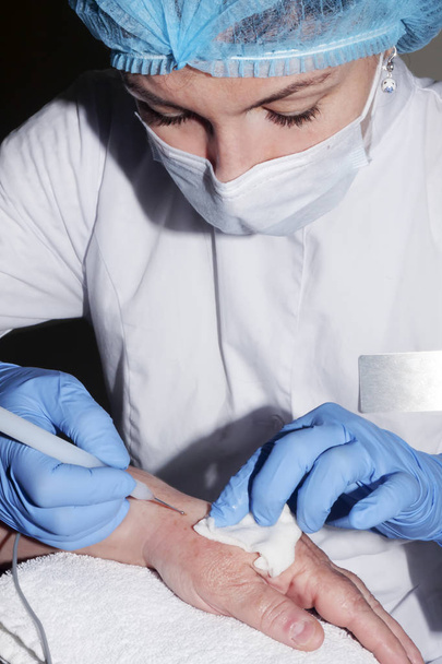 Microcirugía: Dermatólogo médico extirpando desesas de la piel
 - Foto, Imagen