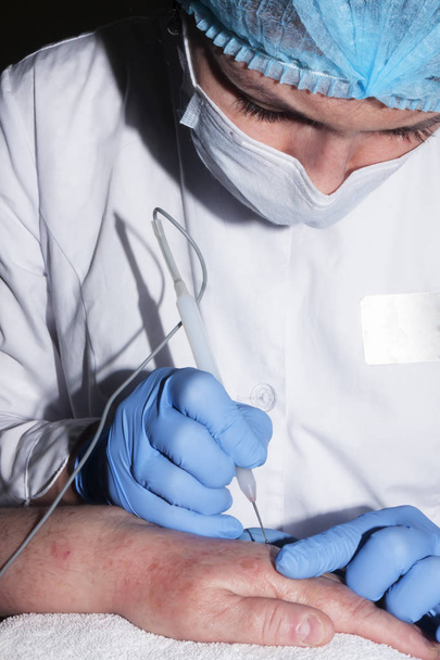 Microcirugía: Dermatólogo médico extirpando desesas de la piel
 - Foto, imagen