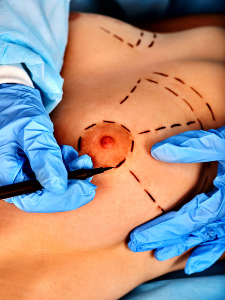 Cirurgia mamária da parte do corpo. Implantes para aumento
. - Foto, Imagem