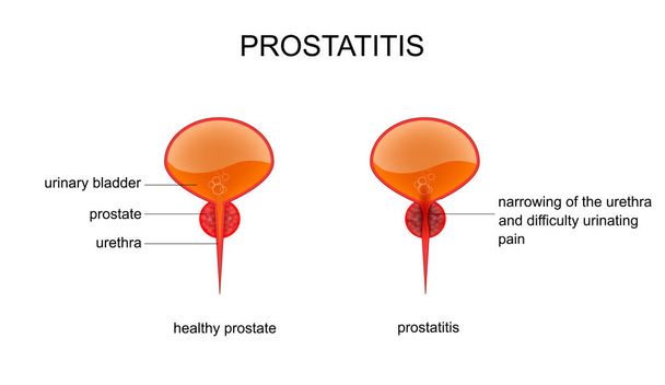 Zdrowa prostata i zapalenie gruczołu krokowego - Wektor, obraz