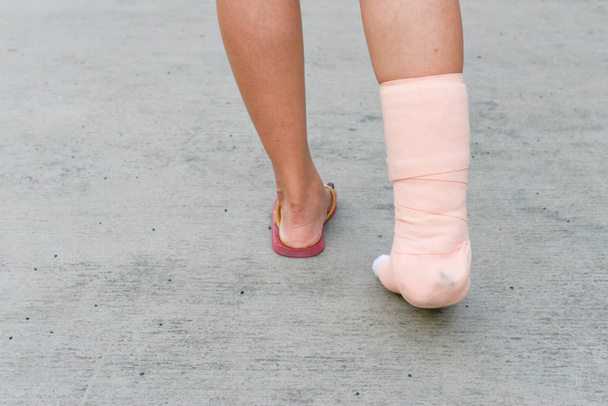 Piede donna con stecca sulla gamba
 - Foto, immagini