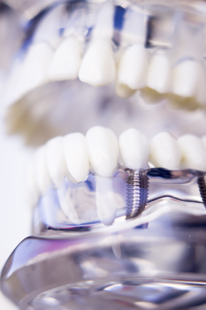 Hammaslääkärit hammasimplantti
 - Valokuva, kuva