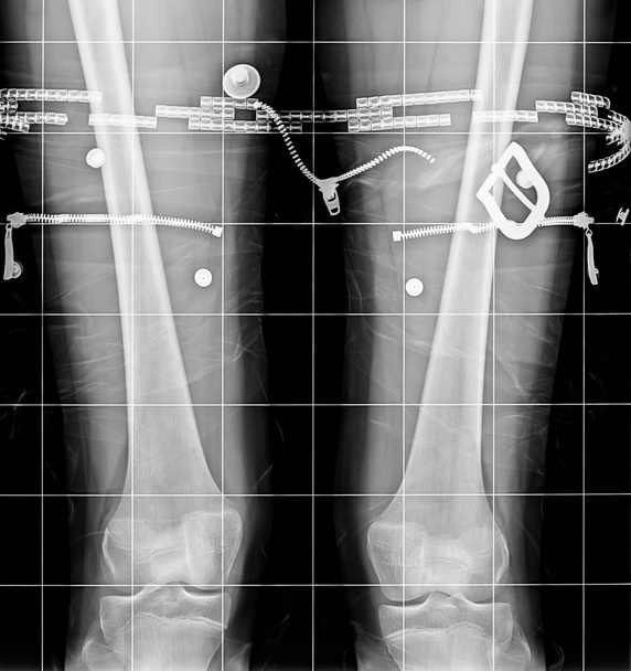 X-Ray a térde - Fotó, kép