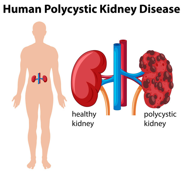 Diagram met menselijke polycysteuze nierziekte - Vector, afbeelding
