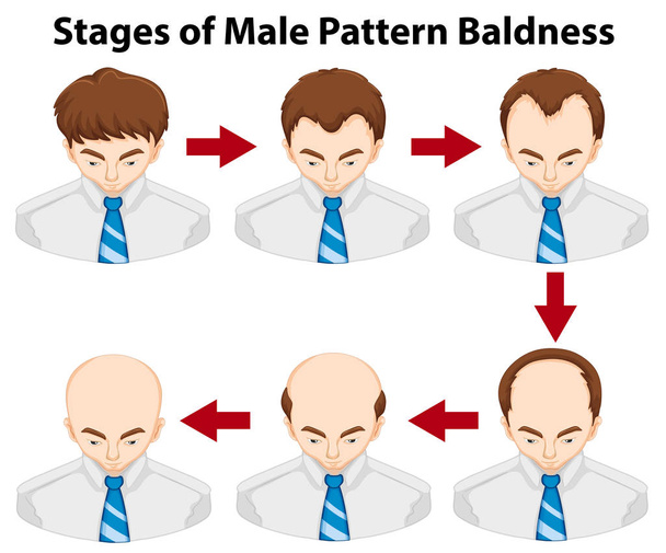 Diagrama que muestra las etapas de la calvicie de patrón masculino
 - Vector, imagen