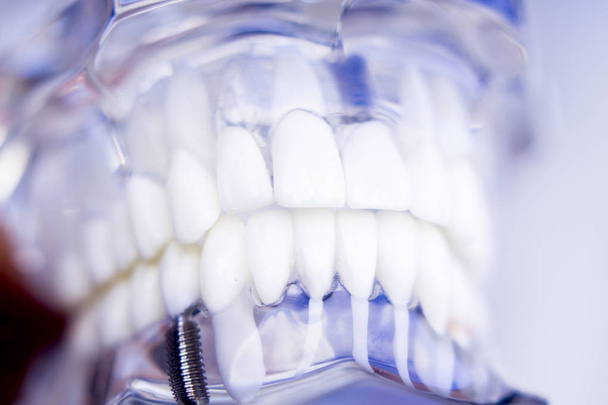 Dentistas implantam dentes dentários
 - Foto, Imagem