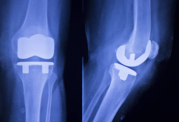 Raio-x do implante articular do joelho
 - Foto, Imagem