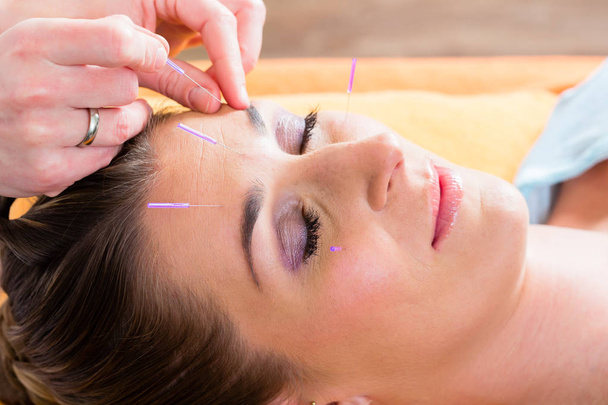 Ajuste del terapeuta agujas de acupuntura
 - Foto, imagen