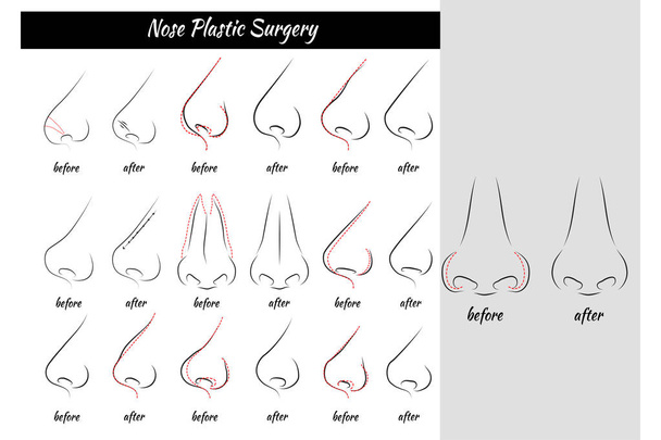 Plastic Surgery. Nose.  - Vector, Image