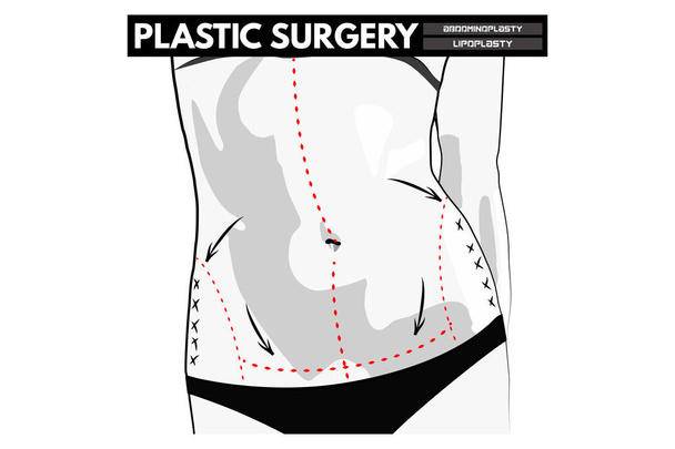  Plastic Surgery. Vector Illustration. - Vector, Image