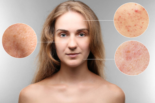 Acne and skin care concept. Young woman before and after cosmetic procedure on gray background - Fotografie, Obrázek