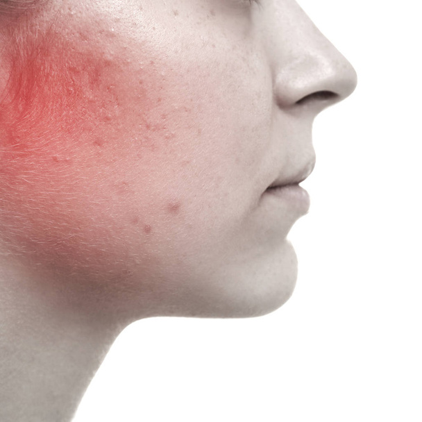 Skin care concept. Young woman with acne, closeup - Φωτογραφία, εικόνα