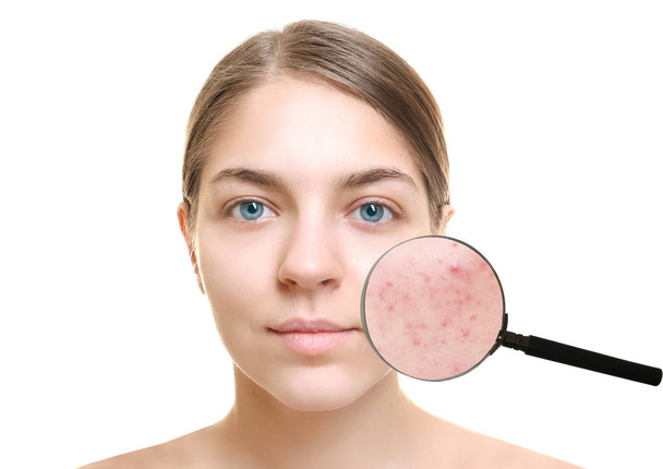 Acne and skin care concept. Young woman before and after cosmetic procedure on white background - Fotó, kép