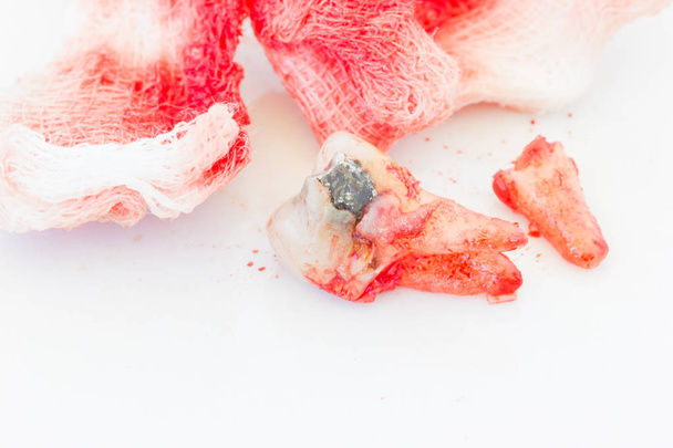Szuvas fogak fehér háttér véres Mull-lap kivonása. egészségügyi koncepció - Fotó, kép