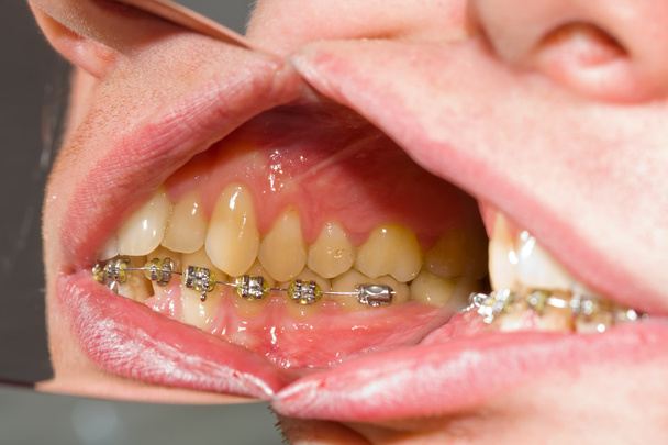 Appareils dentaires sur les dents - traitement orthodontique
 - Photo, image