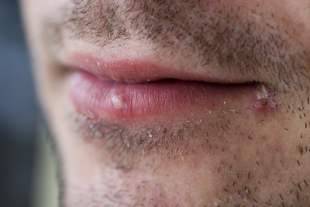 Lippenherpes (Herpes labialis)) - Foto, Bild