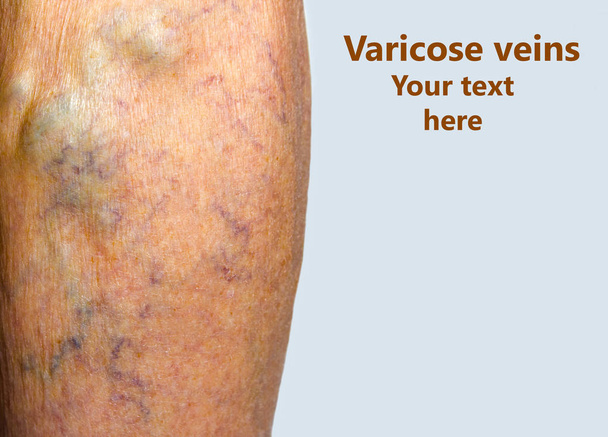 Venas varicosas en una pierna
 - Foto, imagen