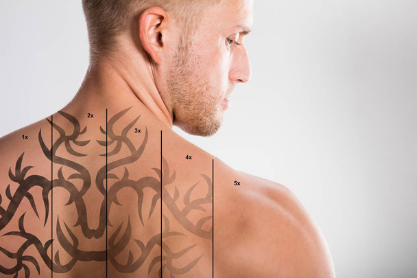 Laser Tattoo Removal - Foto, afbeelding