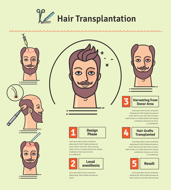 Illustrated vektorové sada s operaci transplantace vlasů - Vektor, obrázek