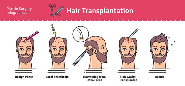 Vector Illustrated set with hair transplant surgery - Vector, Image