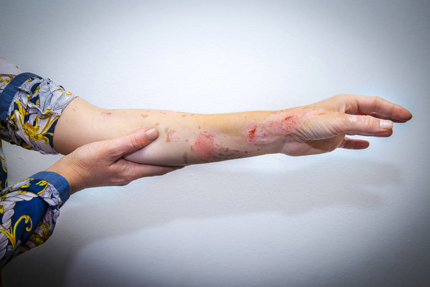 Quemaduras en la piel del brazo humano
 - Foto, Imagen