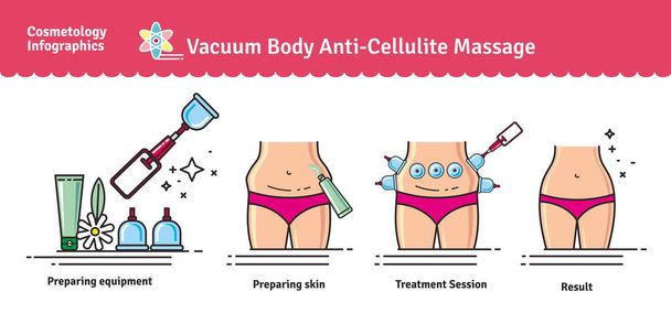 Vektor illustriertes Set mit Salon-Vakuum-Körpermassage gegen Cellulite - Vektor, Bild