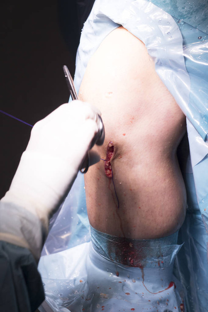 Хирургическая операция на колене
 - Фото, изображение