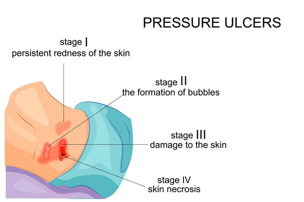 etapas de úlceras en la cama
 - Vector, Imagen
